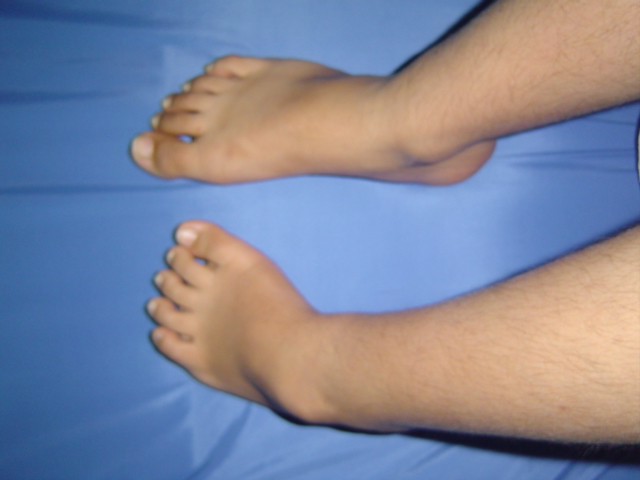 Compare Both Feet (Before Surgery)