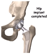 Hip Implant Completed